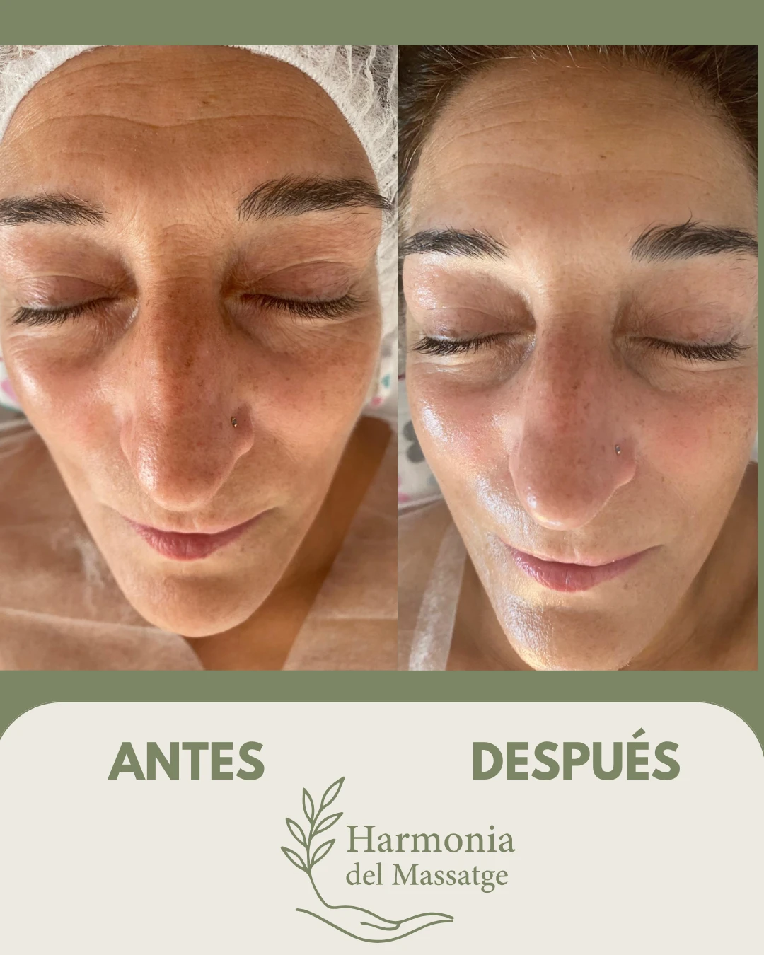 Antes y después de un tratamiento facial en Harmonia del Massatge