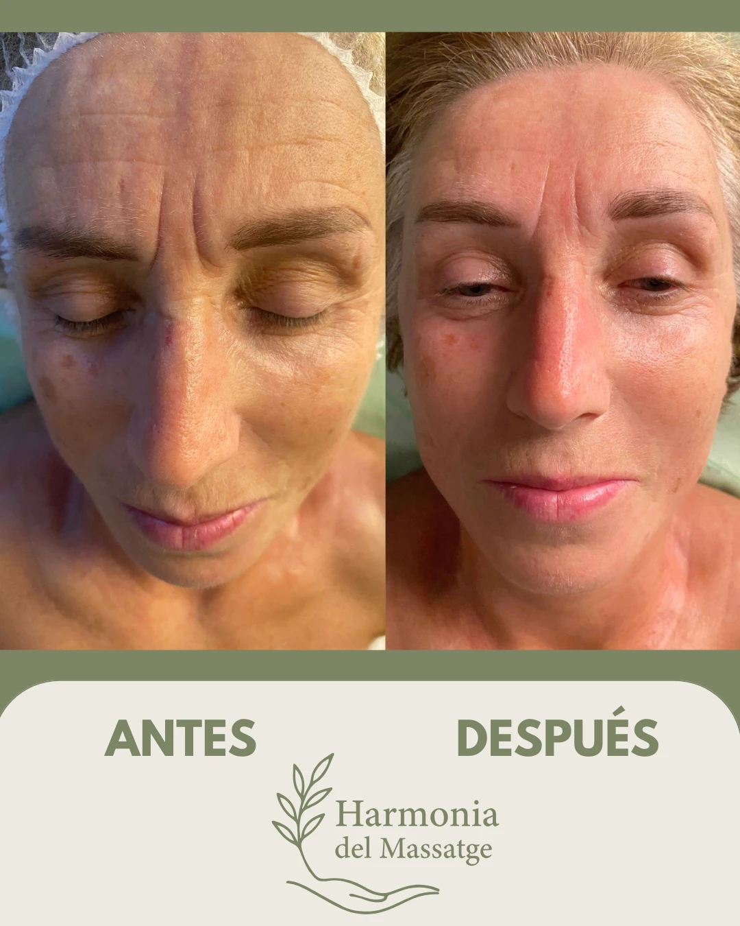 Resultado antes y después de un tratamiento facial en Harmonia del Massatge