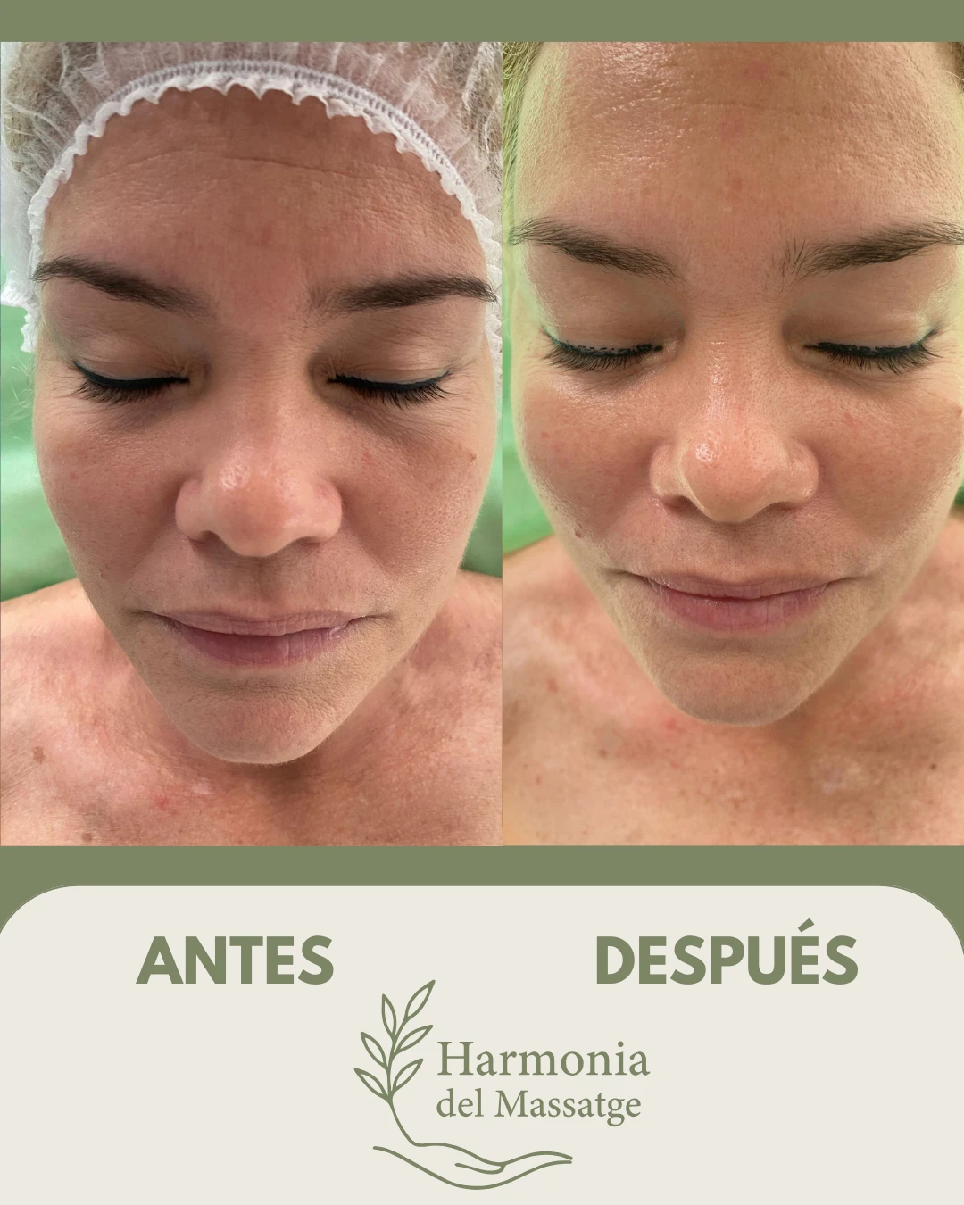 Comparación antes y después de un tratamiento facial en Harmonia del Massatge