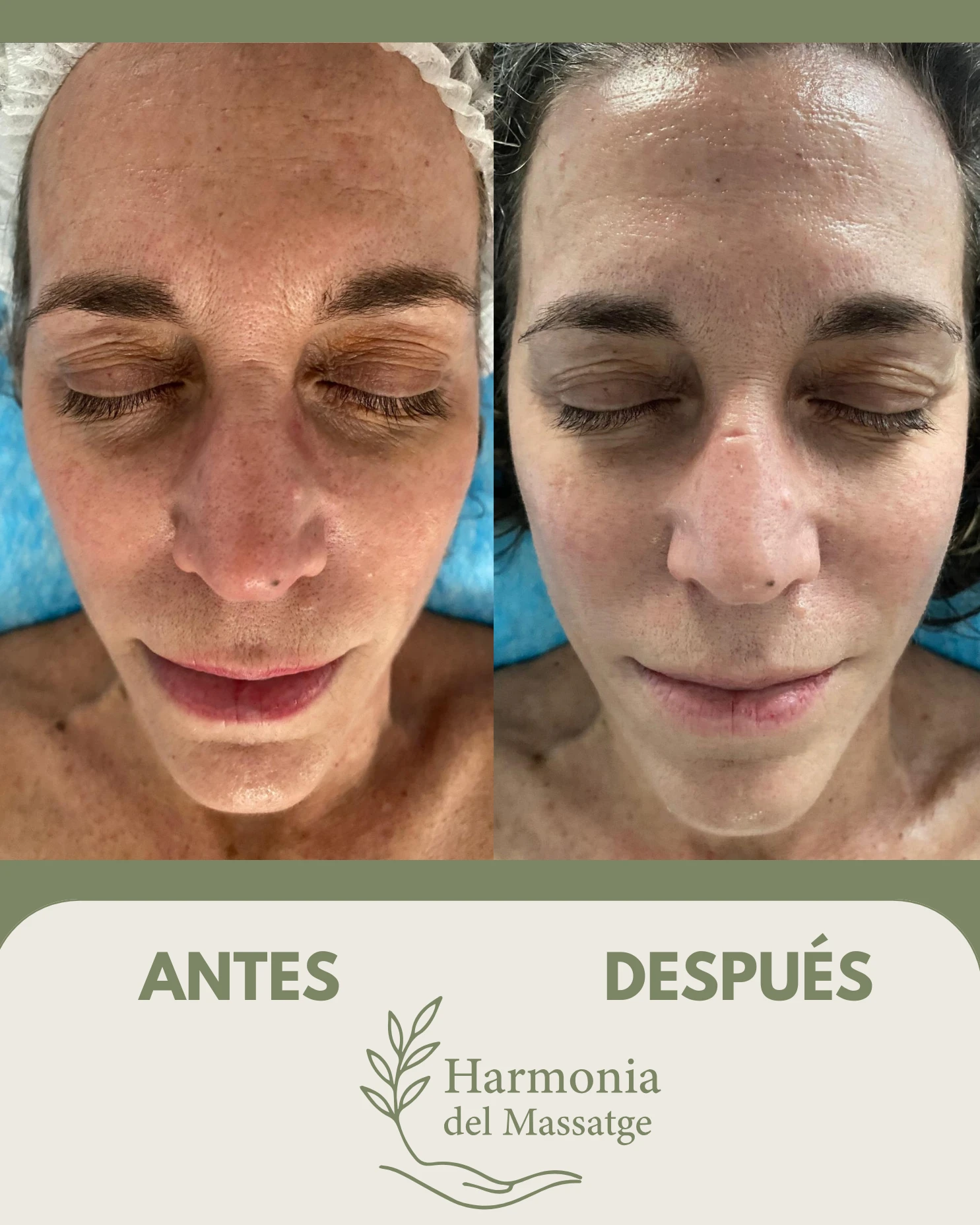 Evolución antes y después de un tratamiento facial en Harmonia del Massatge